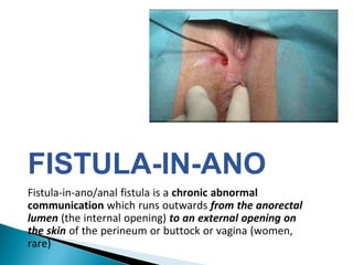 FISTULA-IN-ANO
Fistula-in-ano/anal fistula is a chronic abnormal
communication which runs outwards from the anorectal
lumen (the internal opening) to an external opening on
the skin of the perineum or buttock or vagina (women,
rare)
 