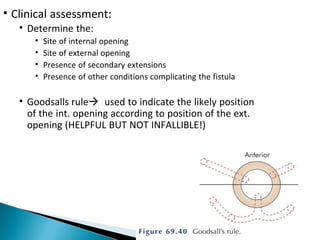 • Clinical assessment:
• Determine the:
• Site of internal opening
• Site of external opening
• Presence of secondary extensions
• Presence of other conditions complicating the fistula
• Goodsalls ruleused to indicate the likely position
of the int. opening according to position of the ext.
opening (HELPFUL BUT NOT INFALLIBLE!)
 