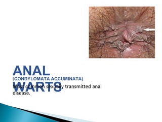 ANAL
WARTS
(CONDYLOMATA ACCUMINATA)
Most common sexually transmitted anal
disease.
 