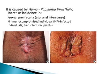 Increase incidence in:
•sexual promiscuity (esp. anal intercourse)
•immunocompromised individual (HIV-infected
individuals, transplant recipients)
 