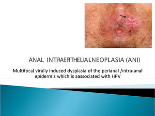 Multifocal virally induced dysplasia of the perianal /intra-anal
epidermis which is aassociated with HPV
 
