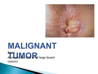 MALIGNANT
TUMOR
Rare!
Accounts for <2% of all large bowel
cancers
 