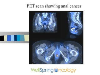 PET scan showing anal cancer
 