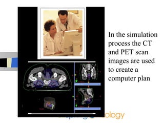In the simulation
process the CT
and PET scan
images are used
to create a
computer plan
 