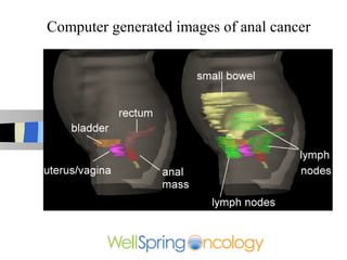 Computer generated images of anal cancer
 