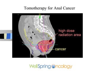 Tomotherapy for Anal Cancer
 