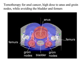 Tomotherapy for anal cancer, high dose to anus and groin
nodes, while avoiding the bladder and femurs
 