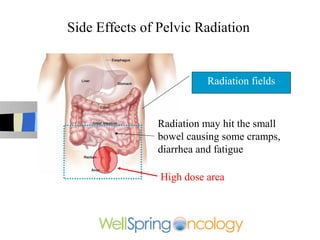 Side Effects of Pelvic Radiation


                          Radiation fields



               Radiation may hit the small
               bowel causing some cramps,
               diarrhea and fatigue

                High dose area
 