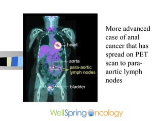 More advanced
case of anal
cancer that has
spread on PET
scan to para-
aortic lymph
nodes
 