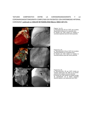 “ESTUDIO    COMPARATIVO         ENTRE   LA        CORONARIOANGIOGRAFÍA                  Y          LA
CORONARIOANGIOTOMOGRAFÍA COMPUTADA EN PACIENTES CON ENFERMEDAD ARTERIAL
CORONARIA” publicado en ANALES DE RADIOLOGIA México 2006;3:201-214.



                     Figura 1                       Figuras 1a y 1b.
                                                    a. Reconstrucción 3D por CATC de la arteria
                                                    descendente anterior en un paciente sano.
                                                    b. Estudio por CAG donde se muestra la
                                                    coronaria izquierda sana del mismo paciente.




                     a                        b
                     Figura 2
                                                    Figuras 2a y 2b.
                                                    a. Reconstrucción 3D por CATC de la arteria
                                                    coronaria derecha en un paciente sano.
                                                    b. Estudio por CAG donde se muestra la
                                                    coronaria derecha sana del mismo paciente.




                     a                       b
                Figura 3
                                                    Figuras 3a y 3b.
                                                    a. Reconstrucción 3D por CATC donde se
                                                    muestra obstrucción del 100% en la porción
                                                    proximal de la arteria coronaria derecha.
                                                    b. Estudio por CAG donde se muestra la falta
                                                    de opacificación de la arteria coronaria
                                                    derecha debido a una obstrucción del 100%.




                 a                        b
 