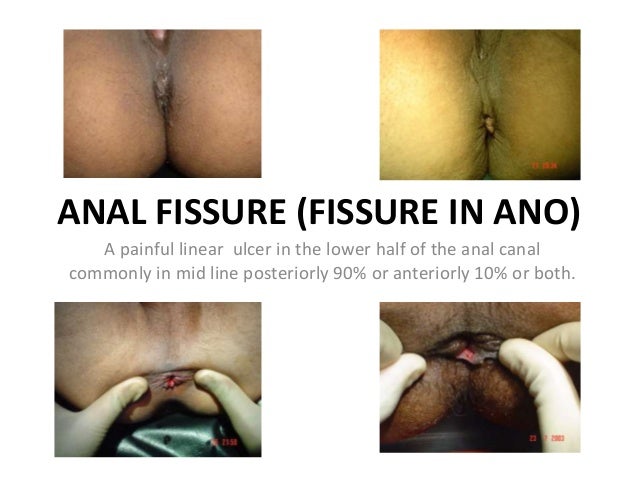 ANAL FISSURE (FISSURE IN ANO)
A painful linear ulcer in the lower half of the anal canal
commonly in mid line posteriorly 90% or anteriorly 10% or both.
 