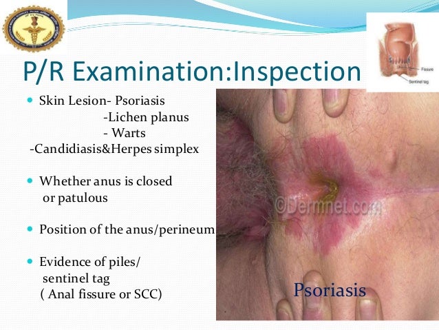 Herpes Around the Anus - www.HemorrhoidsHemroids.com