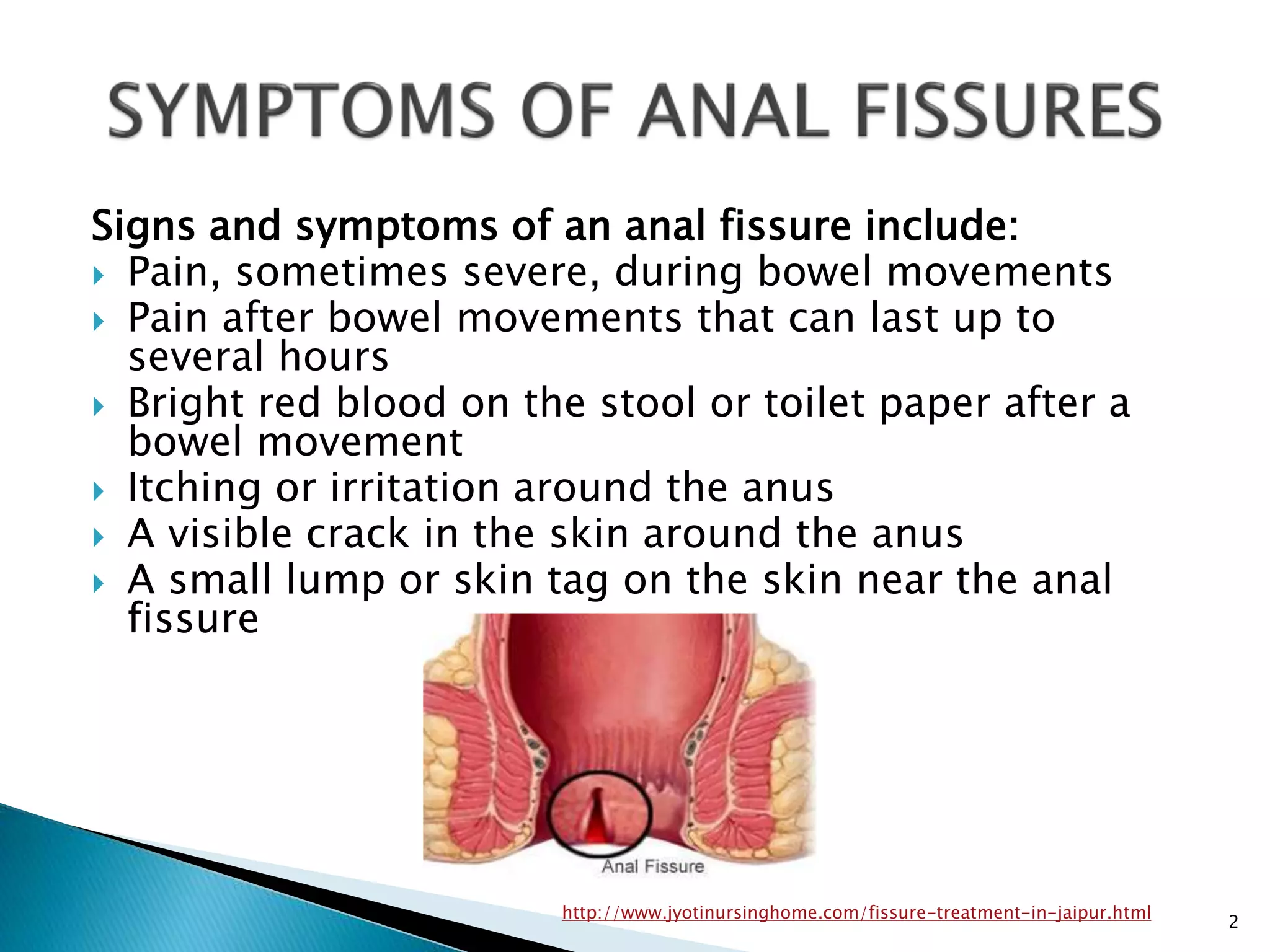 What are Anal Fissures? Symptoms,causes,Risk Factors & Treatment | PPTX