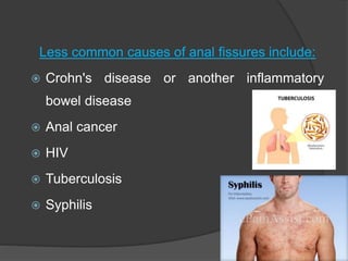 Less common causes of anal fissures include:
 Crohn's disease or another inflammatory
bowel disease
 Anal cancer
 HIV
 Tuberculosis
 Syphilis
 