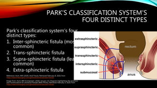 Anal Fistula | PPTX