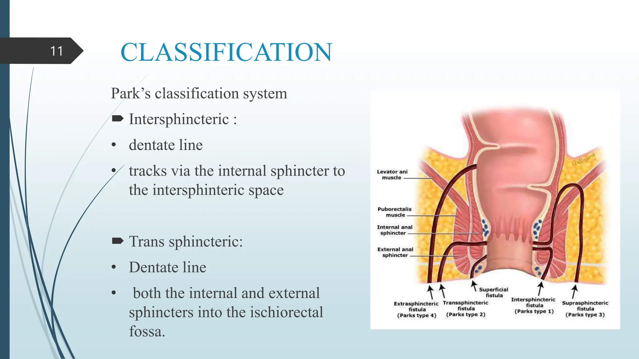ANAL FISTULA a surgical dissection including treatment | PPTX