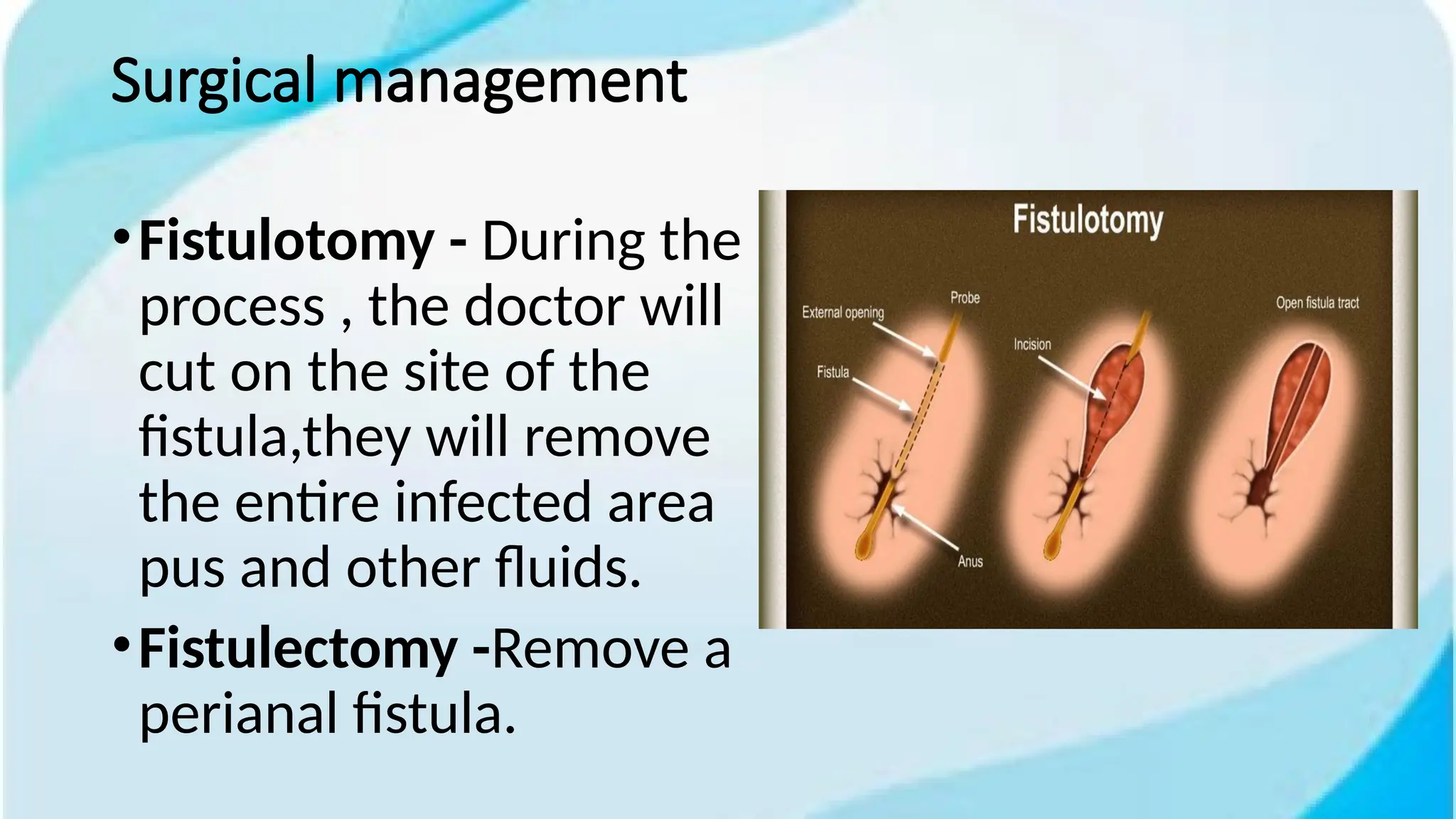 anal fistula .pptx (1).pptx. what is anal fistula underlying the ...