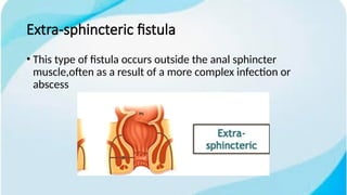 anal fistula .pptx (1).pptx. what is anal fistula underlying the ...