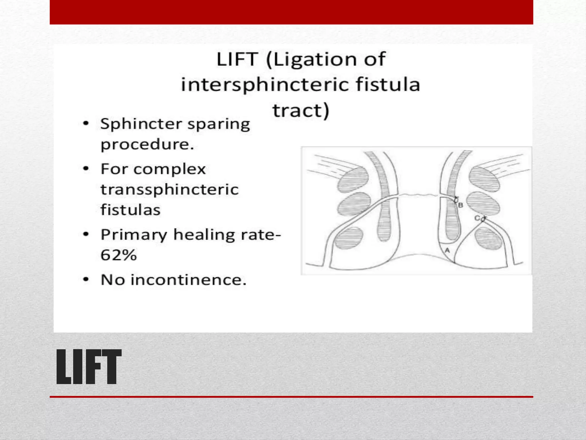 Anal Fistula Presentation Dr Islam Alatiar MRCS PPT Anal Fistula Presentation Dr Islam Alatiar MRCS PPT