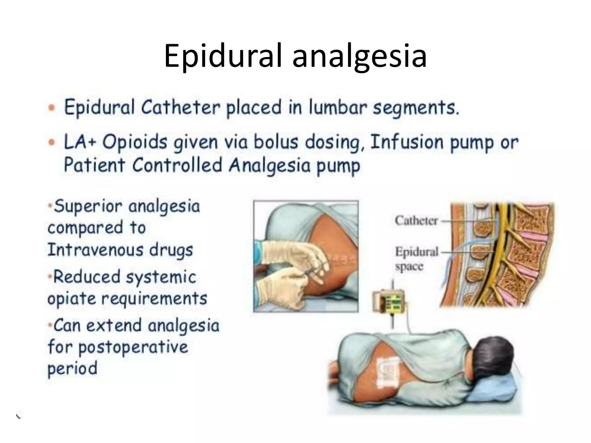 analgesia.pptx