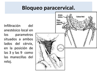 Paracervical Injection Analgesia y-anestesia obstetricia | PPT