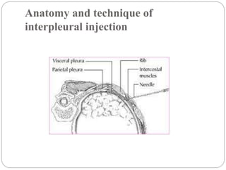 Analgesia in thoracic surgery. | PPTX