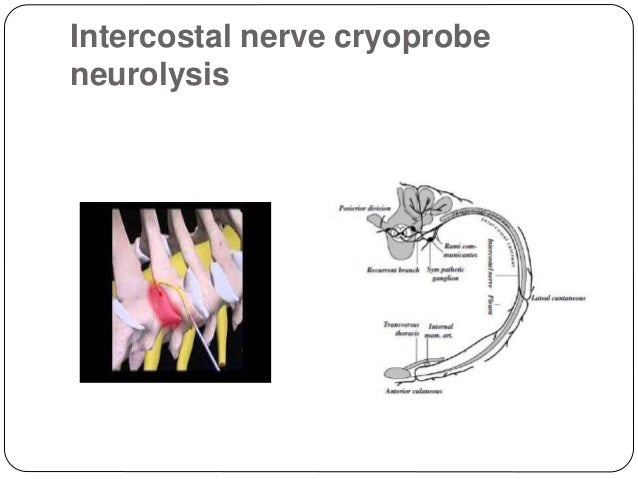 nerves for paracetamol thoracic in surgery. Analgesia
