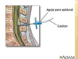 Analgesia Y Anestesia ObstéTrica | PPT