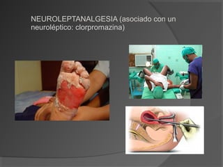NEUROLEPTANALGESIA (asociado con un
neuroléptico: clorpromazina)
 