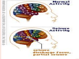 Analgésicos Opióides e Anticonvulsionantes
