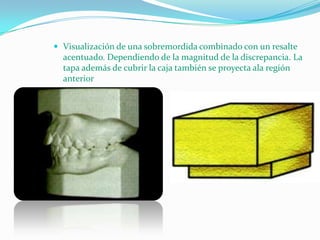  Visualización de una sobremordida combinado con un resalte

acentuado. Dependiendo de la magnitud de la discrepancia. La
tapa además de cubrir la caja también se proyecta ala región
anterior

 