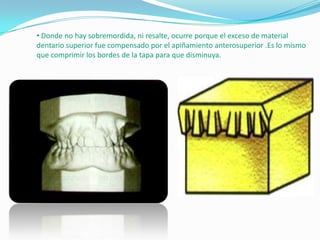 • Donde no hay sobremordida, ni resalte, ocurre porque el exceso de material
dentario superior fue compensado por el apiñamiento anterosuperior .Es lo mismo
que comprimir los bordes de la tapa para que disminuya.

 