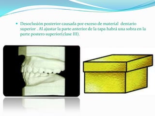  Desoclusión posterior causada por exceso de material dentario

superior . Al ajustar la parte anterior de la tapa habrá una sobra en la
parte postero superior(clase III).

 