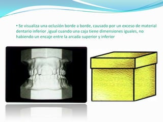 • Se visualiza una oclusión borde a borde, causado por un exceso de material
dentario inferior ,igual cuando una caja tiene dimensiones iguales, no
habiendo un encaje entre la arcada superior y inferior

 