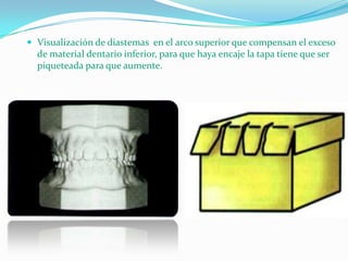  Visualización de diastemas en el arco superior que compensan el exceso

de material dentario inferior, para que haya encaje la tapa tiene que ser
piqueteada para que aumente.

 