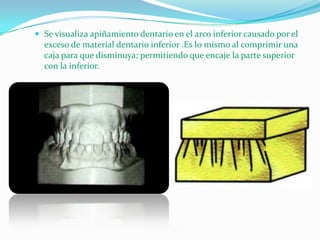  Se visualiza apiñamiento dentario en el arco inferior causado por el

exceso de material dentario inferior .Es lo mismo al comprimir una
caja para que disminuya; permitiendo que encaje la parte superior
con la inferior.

 