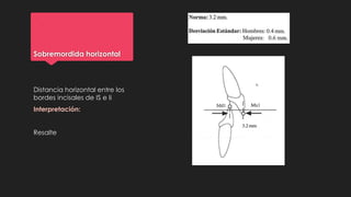 Sobremordida horizontal
Distancia horizontal entre los
bordes incisales de IS e Ii
Interpretación:
Resalte
 