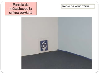 Paresia de
músculos de la
cintura pelviana
NAOMI CANCHE TEPAL
 