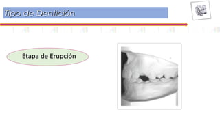 Tipo de DenticiónTipo de Dentición
Etapa de ErupciónEtapa de Erupción
 