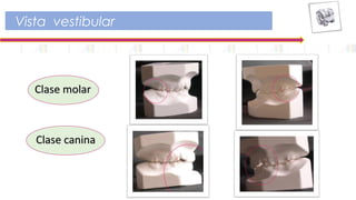 Vista vestibular
Clase molarClase molar
Clase caninaClase canina
 
