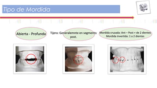 Tipo de Mordida
Abierta - ProfundaAbierta - Profunda Mordida cruzada: Ant – Post + de 2 dientesMordida cruzada: Ant – Post + de 2 dientes
Mordida invertida: 1 a 2 dientesMordida invertida: 1 a 2 dientes
Tijera: Generalemnte en segmentoTijera: Generalemnte en segmento
post.post.
 