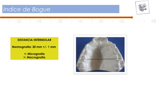 Indice de Bogue
DISTANCIA INTERMOLAR
Normognatia: 30 mm +/- 1 mm
<: Micrognatia
>: Macrognatia
 