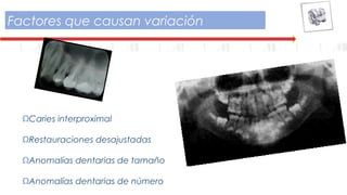 Factores que causan variación
ΩCaries interproximal
ΩRestauraciones desajustadas
ΩAnomalías dentarias de tamaño
ΩAnomalías dentarias de número
 
