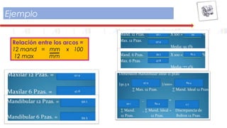 Ejemplo
Relación entre los arcos =
12 mand = mm x 100
12 max mm
 