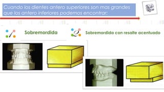 Cuando los dientes antero superiores son mas grandes
que los antero inferiores podemos encontrar:
1 2Sobremordida Sobremordida con resalte acentuado
 
