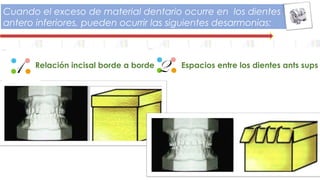 Cuando el exceso de material dentario ocurre en los dientes
antero inferiores, pueden ocurrir las siguientes desarmonias:
1 Relación incisal borde a borde Espacios entre los dientes ants sups2
 