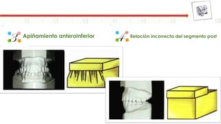 3 Apiñamiento anteroinferior Relación incorrecta del segmento post
4
 