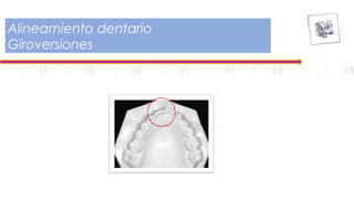 Alineamiento dentario
Giroversiones
 