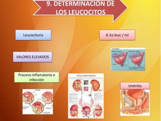9. DETERMINACIÓN DE
LOS LEUCOCITOS
Leucocituria

6-1o leuc / ml

VALORES ELEVADOS

Proceso inflamatorio e
infección
Uretritis

 