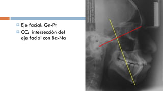 Eje facial: Gn-Pt CC:  intersección del eje facial con Ba-Na  